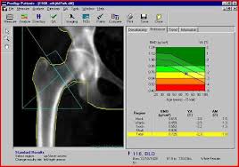 سنجش تراکم استخوان , سنجش پوکی استخوان ,bone densitometry